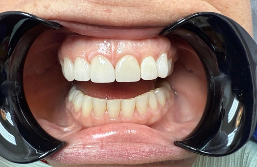 Smile 1 After