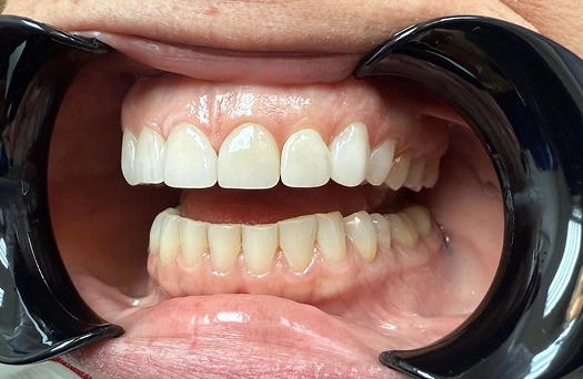Smile 2 After