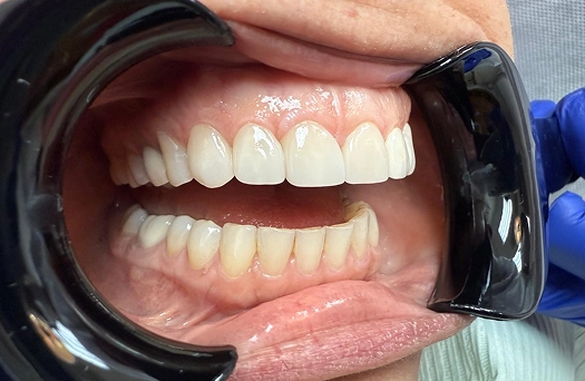 Smile 3 After