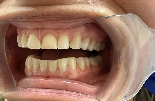 Smile 2 Before