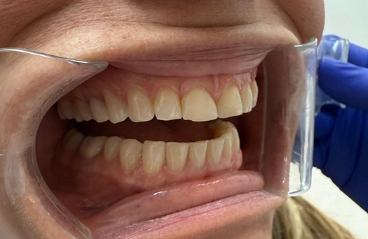 Smile 3 Before